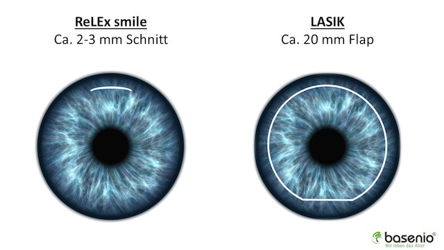 Augen lasern, Relex smile, Lasik, Schnittvergleich
